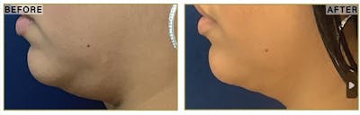 Liposuction Before & After Gallery - Patient 335372 - Image 1
