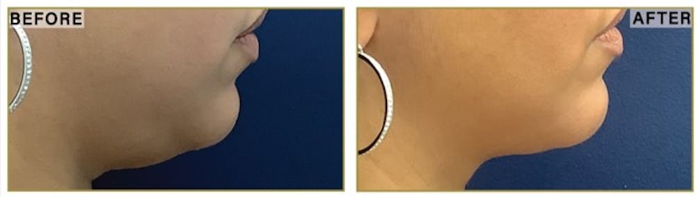 Liposuction Before & After Gallery - Patient 335372 - Image 2