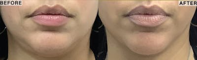 Liposuction Before & After Gallery - Patient 122458 - Image 1