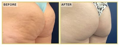 Aveli Before & After Gallery - Patient 353698 - Image 2