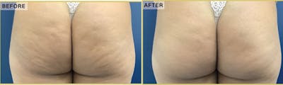 Aveli Before & After Gallery - Patient 394335 - Image 1