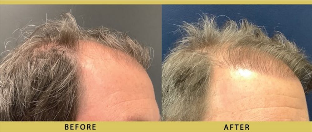 Hair Restoration Before & After Gallery - Patient 349985 - Image 2