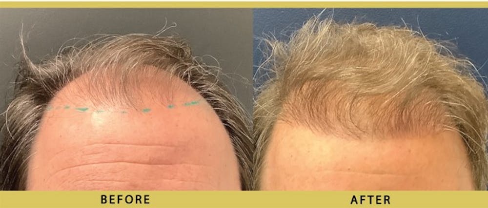 Hair Restoration Before & After Gallery - Patient 349985 - Image 1