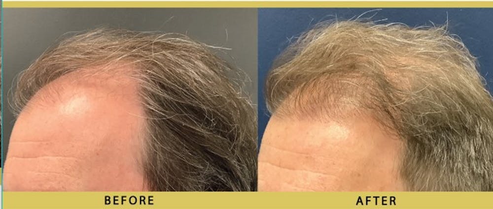 Hair Restoration Before & After Gallery - Patient 349985 - Image 3