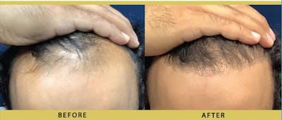 Hair Restoration Before & After Gallery - Patient 257904 - Image 1