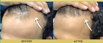 Hair Restoration Before & After Gallery - Patient 257904 - Image 2