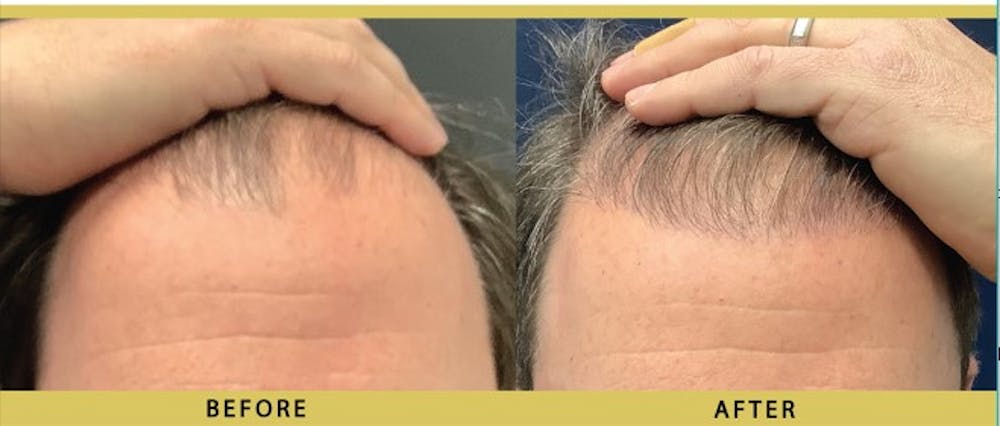 Hair Restoration Before & After Gallery - Patient 343266 - Image 1