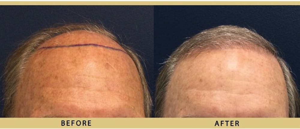 Hair Restoration Before & After Gallery - Patient 156941 - Image 1