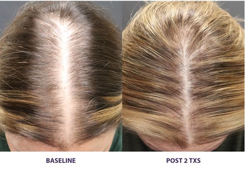 TED Hair Restoration Before & After Gallery - Patient 254348 - Image 1