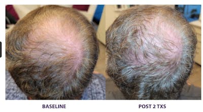TED Hair Restoration Before & After Gallery - Patient 955235 - Image 1