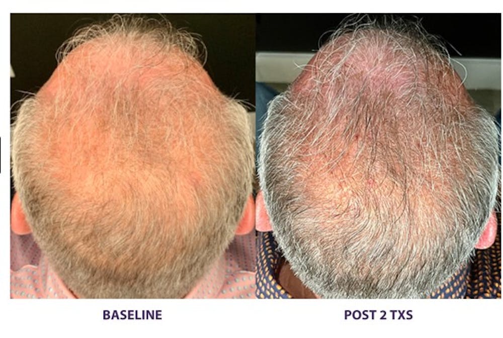 TED Hair Restoration Before & After Gallery - Patient 314582 - Image 1