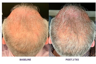 TED Hair Restoration Before & After Gallery - Patient 314582 - Image 1