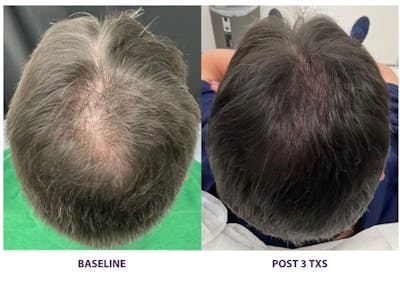 TED Hair Restoration Before & After Gallery - Patient 348822 - Image 1