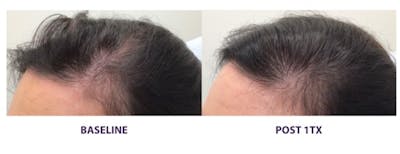 TED Hair Restoration Before & After Gallery - Patient 360062 - Image 1