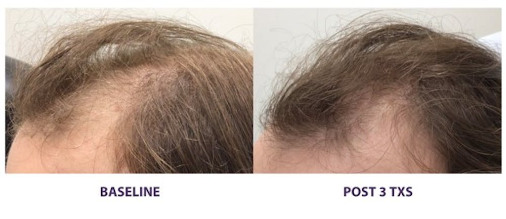 TED Hair Restoration Before & After Gallery - Patient 118651 - Image 1