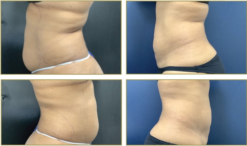 Liposuction Before & After Gallery - Patient 354929 - Image 1