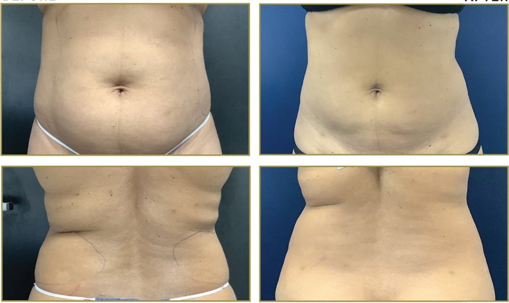 Liposuction Before & After Gallery - Patient 354929 - Image 2