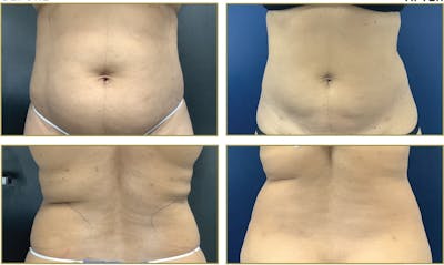 Liposuction Before & After Gallery - Patient 354929 - Image 2