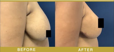 Breast Augmentation Before & After Gallery - Patient 302043 - Image 2