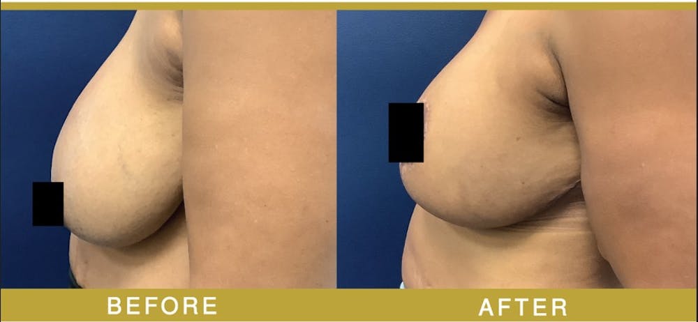 Breast Augmentation Before & After Gallery - Patient 302043 - Image 3