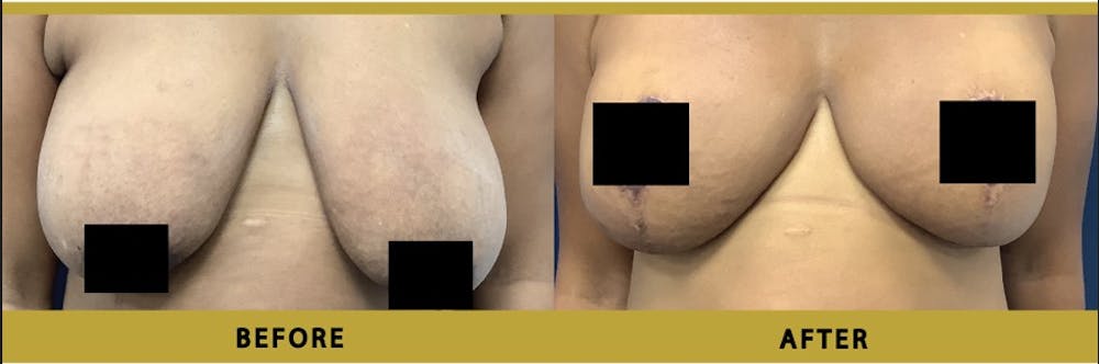 Breast Augmentation Before & After Gallery - Patient 302043 - Image 1