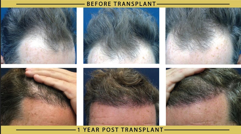 Hair Restoration Before & After Gallery - Patient 292517 - Image 1