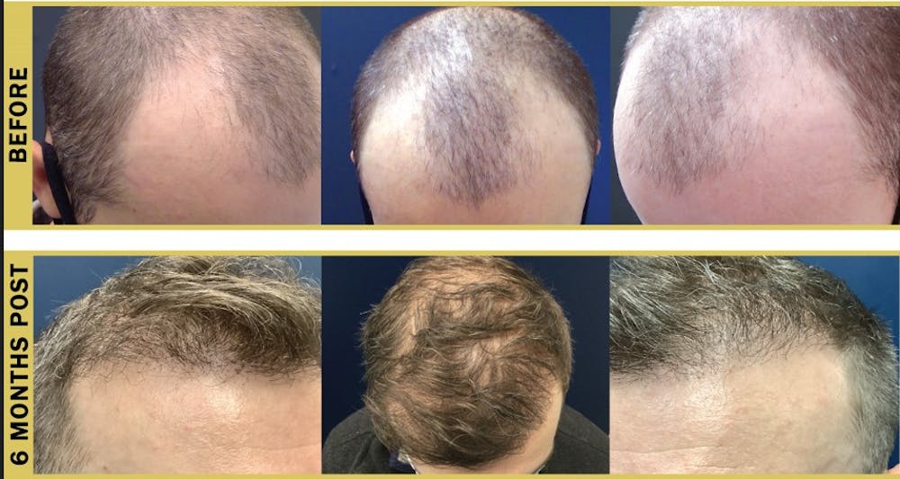 Hair Restoration Before & After Gallery - Patient 139565 - Image 1
