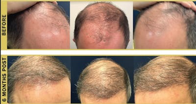 Hair Restoration Before & After Gallery - Patient 357001 - Image 1