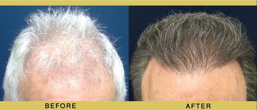 Hair Restoration Before & After Gallery - Patient 263524 - Image 1