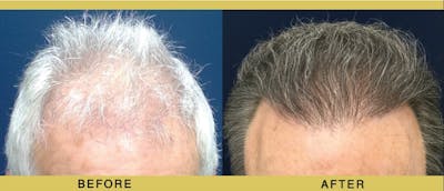 Hair Restoration Before & After Gallery - Patient 263524 - Image 1