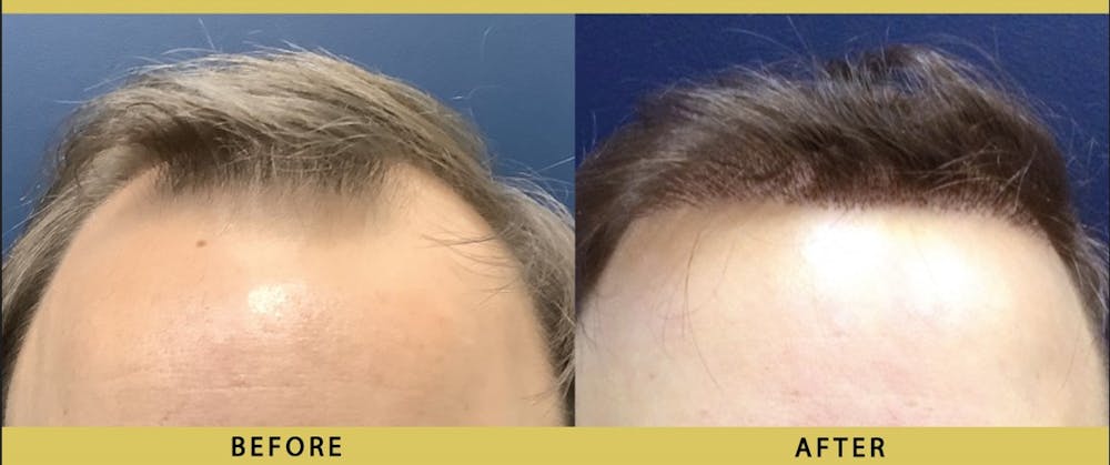 Hair Restoration Before & After Gallery - Patient 355556 - Image 1