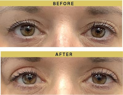 Eyelid Surgery Before & After Gallery - Patient 158679 - Image 1