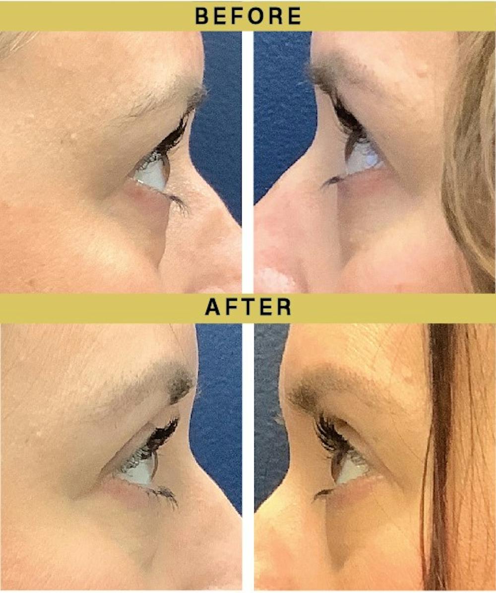 Eyelid Surgery Before & After Gallery - Patient 228719 - Image 1