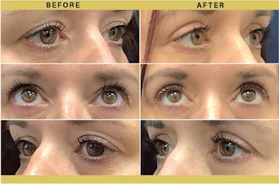 Eyelid Surgery Before & After Gallery - Patient 403632 - Image 1