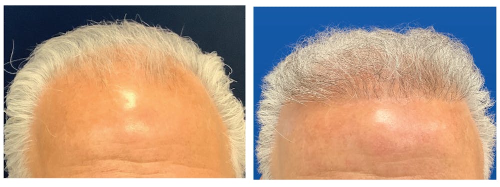 Hair Restoration Before & After Gallery - Patient 247337 - Image 1