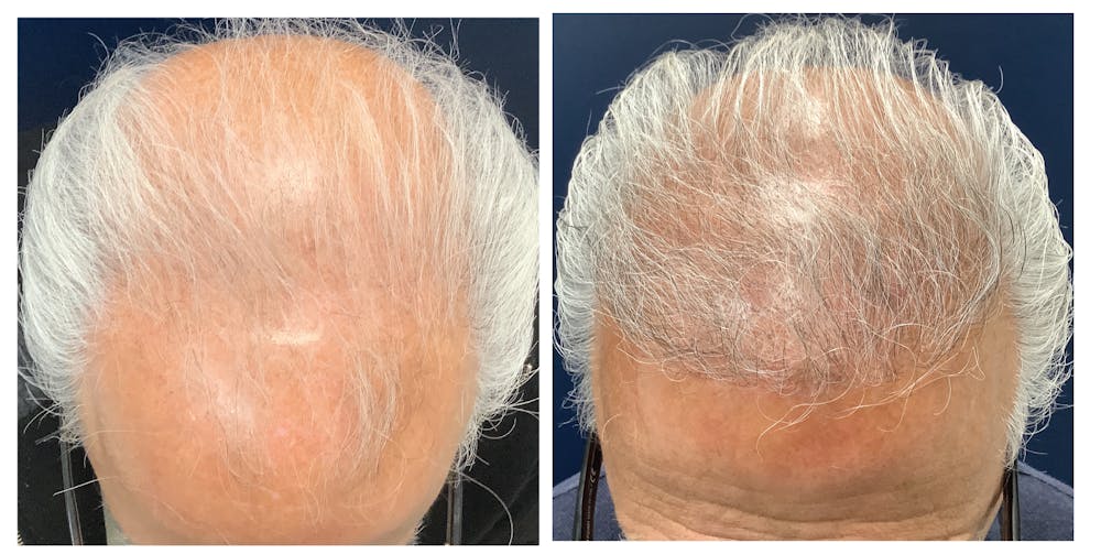 Hair Restoration Before & After Gallery - Patient 379095 - Image 1