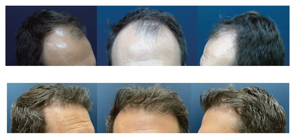 Hair Restoration Before & After Gallery - Patient 268357 - Image 1