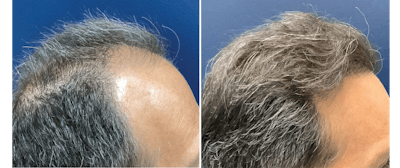Hair Restoration Before & After Gallery - Patient 363618 - Image 1