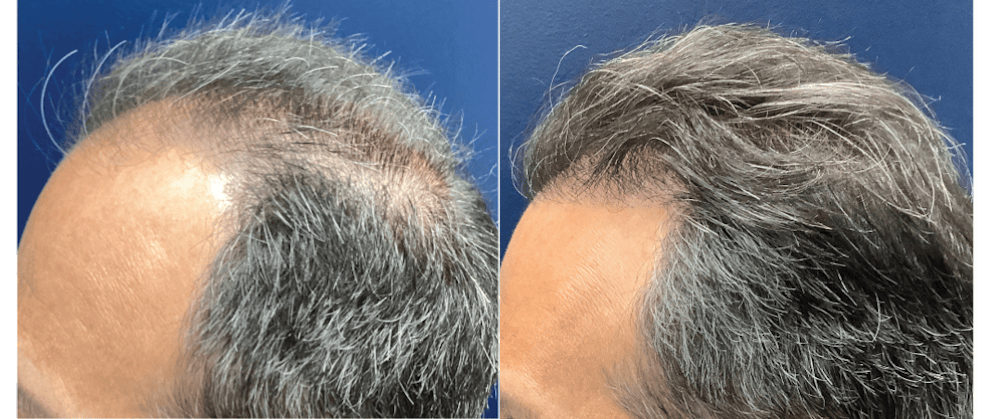 Hair Restoration Before & After Gallery - Patient 363618 - Image 2