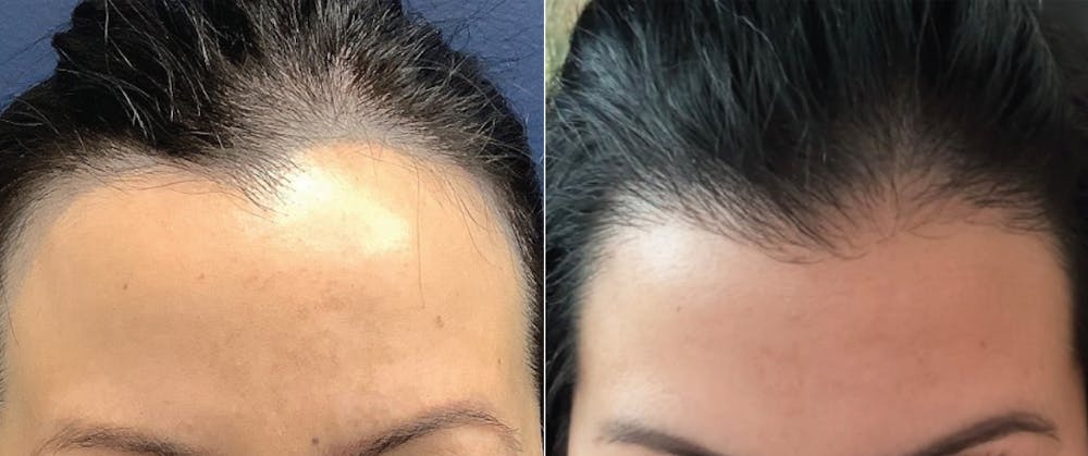 Hair Restoration Before & After Gallery - Patient 362736 - Image 1