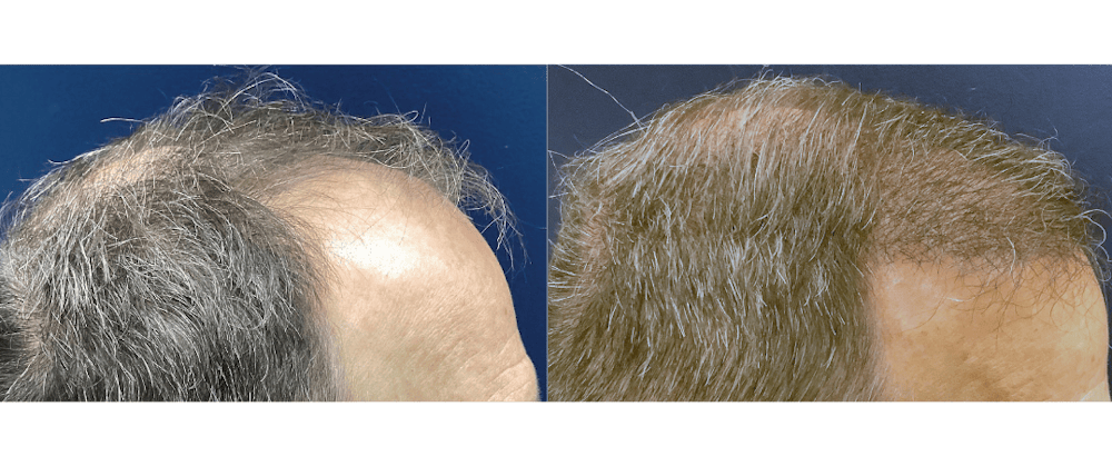 Hair Restoration Before & After Gallery - Patient 203149 - Image 2