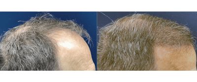 Hair Restoration Before & After Gallery - Patient 203149 - Image 2