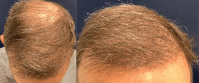 Hair Restoration Before & After Gallery - Patient 203149 - Image 4