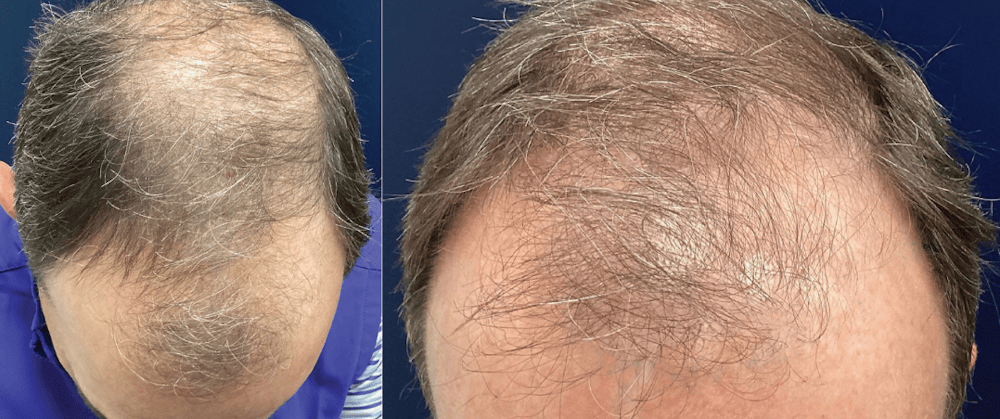 Hair Restoration Before & After Gallery - Patient 203149 - Image 1