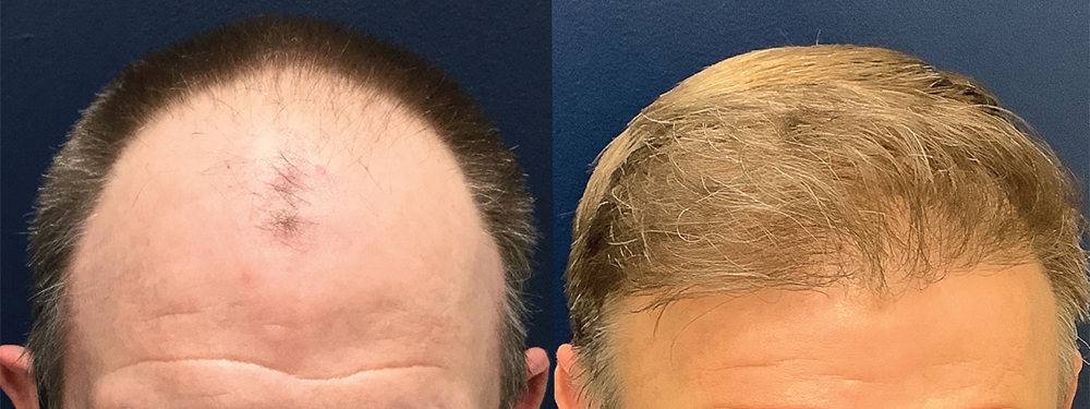 Hair Restoration
