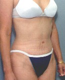 Before and After Tummy Tuck in NYC
