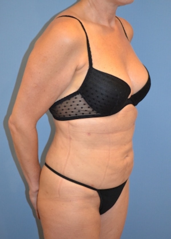 Liposuction