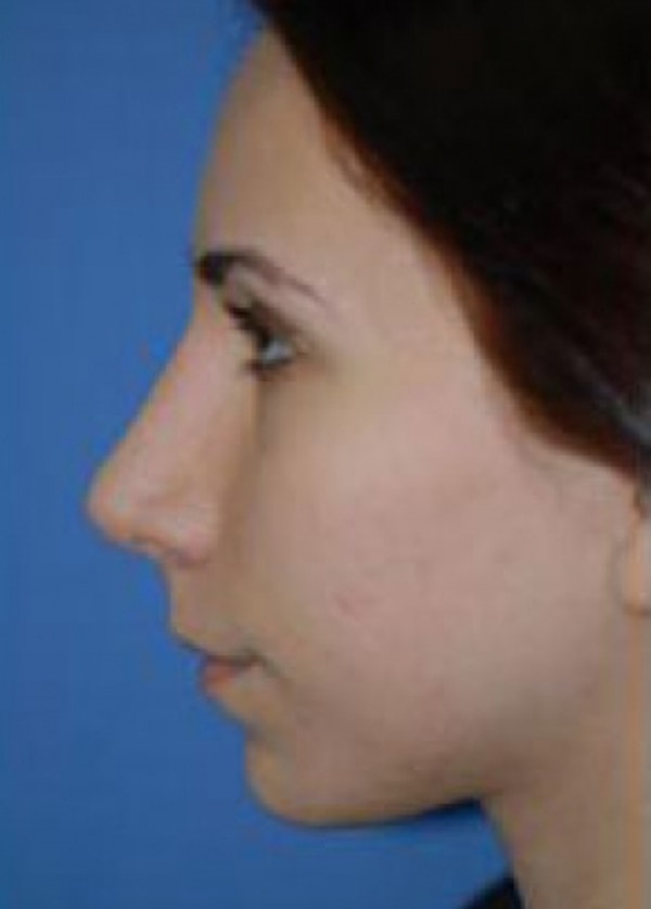 Rhinoplasty