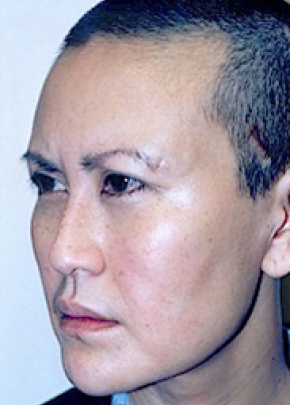 Cheek Lift