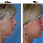 Dr. Miller’s face-lift patient